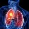 Anatomische Segmentresektionen beim Lungenkrebs